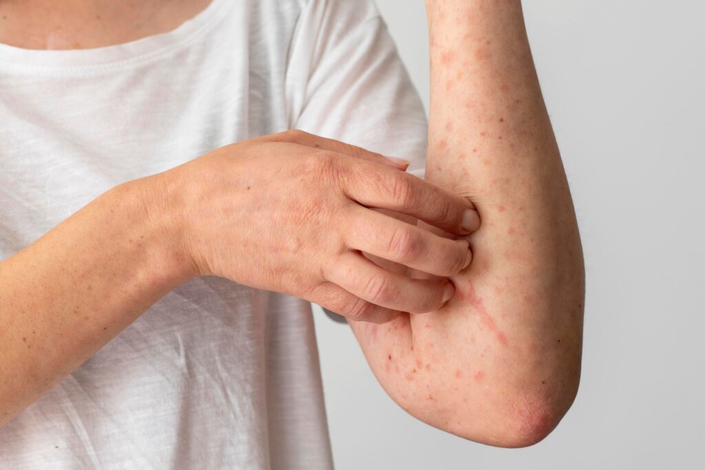 Primer plano de un brazo con erupción cutánea rojiza característica del sarampión, mientras la persona se rasca la zona afectada.