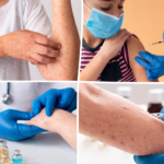 Collage de imágenes que muestran erupciones cutáneas asociadas al sarampión en brazos de adultos y menores, así como personal médico aplicando una vacuna y realizando revisión clínica con guantes.